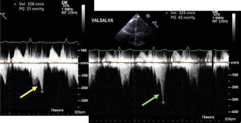 mid cavitary gradient echo